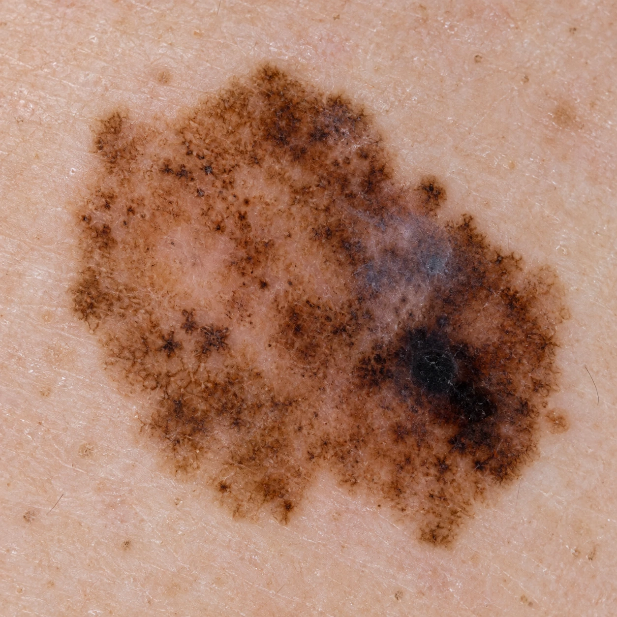 Dermatoscopia gerada por IA para o caso fictício F-01